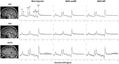 Chronic neuropathic pain components in whiplash-associated disorders correlate with metabolite concentrations in the anterior cingulate and dorsolateral prefrontal cortex: a consensus-driven MRS re-examination